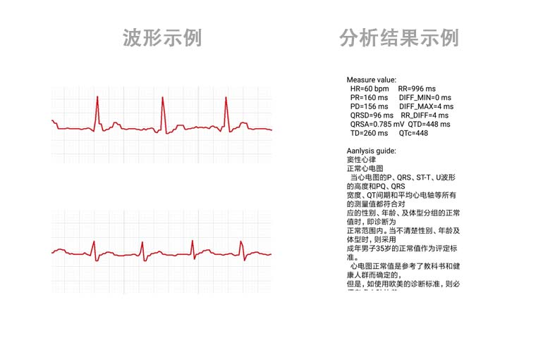 心電數(shù)據(jù)SDK算法庫(kù)----心電芯片、心電手環(huán)芯片、可穿戴心電設(shè)備、智能監(jiān)護(hù)儀